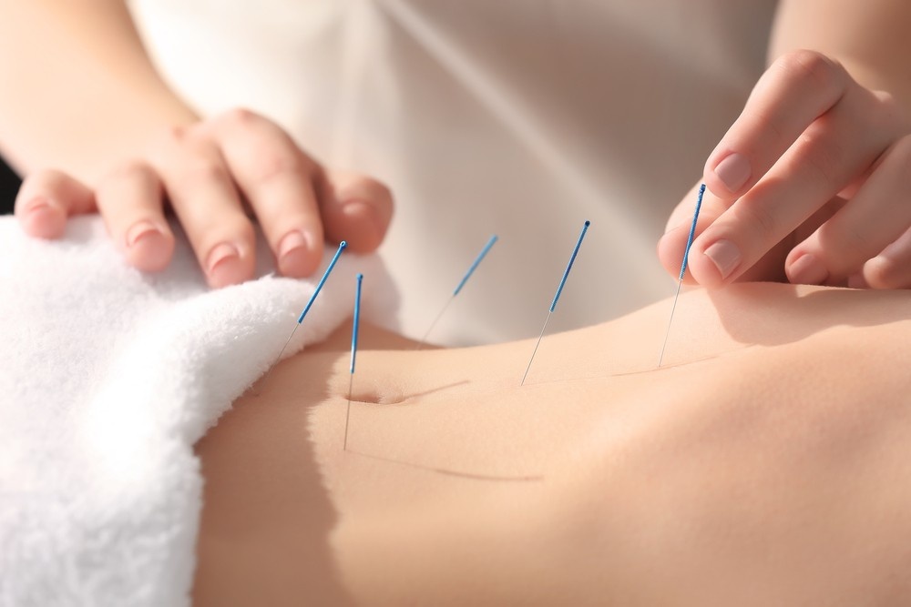 Accupencture